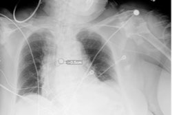 Plain chest radiograph showing overlay from Critical Care Suite, with segmentation of ETT, identification of tube tip and carina, and calculation of distance between them.