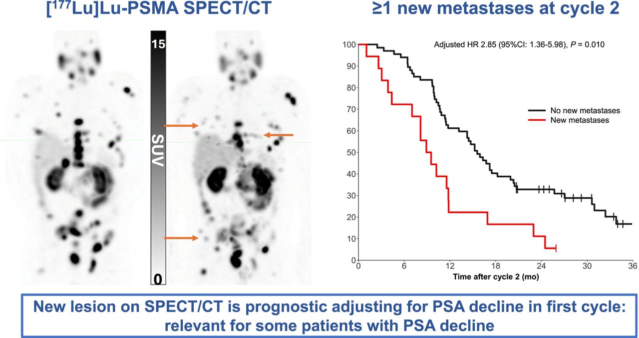 SPECT/CT identifies prostate cancer patients with poor outcomes ...