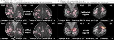 (A) Fixations (pink circles) of a radiologist while reading without and with AI support on a screening mammogram in a 72-year-old woman without breast cancer. The radiologists did not recall the woman in either reading condition. The mean breast fixation coverage for this radiologist was 12.3% without AI support and 9.2% with AI support. The AI tool classified this examination as low risk, with a maximum region score under 40. (B) Fixations of a radiologist while reading without and with AI support on a screening mammogram in a 50-year-old woman with invasive carcinoma of no special type located dorso-laterally in the left breast. The radiologist recalled this woman in both reading conditions, with a mean breast fixation coverage of 8.5% without AI support and 6.3% with AI support. The AI tool classified this examination as very high risk, with a maximum region score of 80 or higher (red numbers; yellow number represents intermediate risk). Diamonds indicate calcifications, and circles denote soft tissue lesions. Image courtesy of the RSNA.