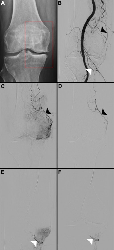 Images in a 65-year-old female patient. (A) Radiograph of the right knee shows Kellgren-Lawrence grade 3 knee osteoarthritis, with chronic pain localized to the medial compartment (red box). (B) Digital subtraction angiogram of the popliteal artery helps identify two potential target arteries: the superior medial genicular artery (black arrowhead) and the inferior medial genicular artery (white arrowhead). (C, E) Selective, pre-embolization digital subtraction angiograms of the superior medial genicular artery (black arrowhead in C) and the inferior medial genicular artery (white arrowhead in E) demonstrate a hyperemic blush in the medial compartment, indicative of pathologic hypervascularity. (D, F) Postembolization digital subtraction angiograms show successful stasis in the superior medial genicular artery (black arrowhead in D) and the inferior medial genicular artery (white arrowhead in F), with complete resolution of the hyperemic blush.