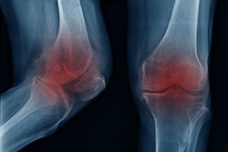 Knee Oa