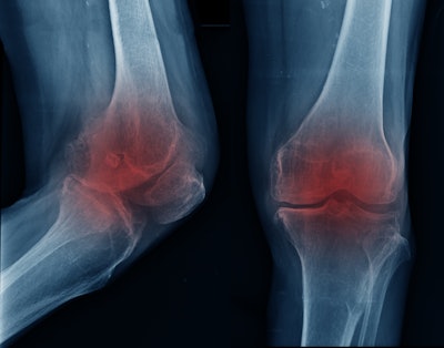 Knee Oa