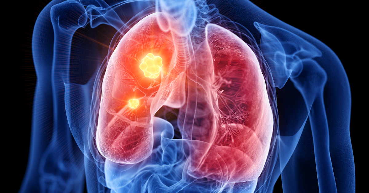 Lung Cancer Hotspot Social