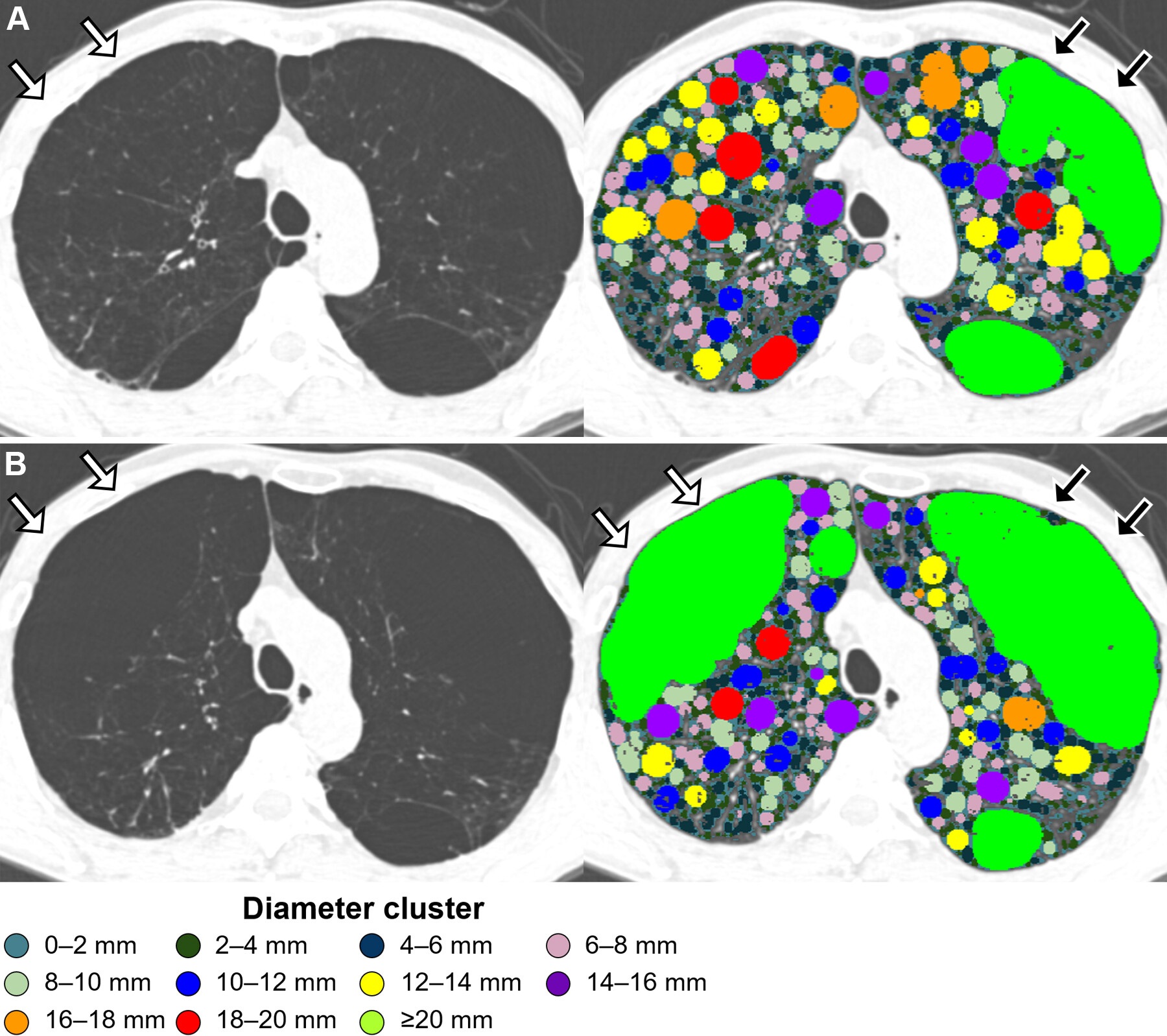 Emphysema progression with hole changes, with holes colored according to their diameter in 2-mm increments. (A) Baseline inspiratory nonenhanced axial CT scans in a 48-year-old man with chronic obstructive pulmonary disease show emphysema holes with hyperexpansion of secondary pulmonary lobules (white arrows) and thin alveolar walls visible in the right upper lobe. This emphysematous lesion is filled with holes of varying sizes. A single large air cyst was observed in the left upper lobe (black arrows), classified as a single emphysema hole of 20 mm or greater (bright green). (B) At six-year follow-up inspiratory nonenhanced axial CT, the holes in the right upper lobe have merged (white arrows), with no visible alveolar septa remaining, resulting in the formation of a large new hole of 20 mm or greater (bright green). Meanwhile, the hole in the left upper lobe also enlarged, merging with adjacent holes (black arrows). The size of other holes in the paramedian left upper lobe decreased.