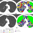 Emphysema progression with hole changes, with holes colored according to their diameter in 2-mm increments. (A) Baseline inspiratory nonenhanced axial CT scans in a 48-year-old man with chronic obstructive pulmonary disease show emphysema holes with hyperexpansion of secondary pulmonary lobules (white arrows) and thin alveolar walls visible in the right upper lobe. This emphysematous lesion is filled with holes of varying sizes. A single large air cyst was observed in the left upper lobe (black arrows), classified as a single emphysema hole of 20 mm or greater (bright green). (B) At six-year follow-up inspiratory nonenhanced axial CT, the holes in the right upper lobe have merged (white arrows), with no visible alveolar septa remaining, resulting in the formation of a large new hole of 20 mm or greater (bright green). Meanwhile, the hole in the left upper lobe also enlarged, merging with adjacent holes (black arrows). The size of other holes in the paramedian left upper lobe decreased.