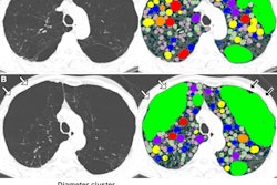 Emphysema progression with hole changes, with holes colored according to their diameter in 2-mm increments. (A) Baseline inspiratory nonenhanced axial CT scans in a 48-year-old man with chronic obstructive pulmonary disease show emphysema holes with hyperexpansion of secondary pulmonary lobules (white arrows) and thin alveolar walls visible in the right upper lobe. This emphysematous lesion is filled with holes of varying sizes. A single large air cyst was observed in the left upper lobe (black arrows), classified as a single emphysema hole of 20 mm or greater (bright green). (B) At six-year follow-up inspiratory nonenhanced axial CT, the holes in the right upper lobe have merged (white arrows), with no visible alveolar septa remaining, resulting in the formation of a large new hole of 20 mm or greater (bright green). Meanwhile, the hole in the left upper lobe also enlarged, merging with adjacent holes (black arrows). The size of other holes in the paramedian left upper lobe decreased.