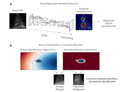 A method overview of the explainable AI model. (A) Diagram shows deep explainable anomaly detection at breast MRI. A maximum intensity projection (MIP) of a breast is passed to a fully convolutional neural network model trained using an explainable anomaly detection loss function (fully convolutional data description [FCDD]). The model directly outputs an up-sampled heat map of the anomalous pixels (anomaly heat map). The mean anomaly score across all pixels is used to classify a case as abnormal (malignant) or not. (B) Diagram shows a conceptual comparison between binary classification and anomaly detection: Shading represents the learned normal (blue) and abnormal (red) feature spaces, and dots represent individual normal (blue) and abnormal (red) cases. Binary classification learns a classification boundary between normal and abnormal cases, but model performance is affected by the scarcity and variability of malignant cases. Anomaly detection focuses on robustly learning the normal class and aims to identify abnormal cases accurately under these conditions.
