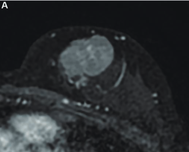 MR image from a 55-year-old patient with triple-negative breast cancer from training set. (A, above) Axial postcontrast T1-weighted image from baseline MRI exam shows unifocal enhancing mass (unifocality: positive). (B, below) Axial postcontrast T1-weighted image from MRI examination per-formed after one cycle of neoadjuvant chemoimmunotherapy shows >37% reduction in lesion size (early tumor shrinkage: positive) and development of non-enhancing region within lesion (percentage enhancement reduction: positive).