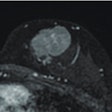 MR image from a 55-year-old patient with triple-negative breast cancer from training set. (A, above) Axial postcontrast T1-weighted image from baseline MRI exam shows unifocal enhancing mass (unifocality: positive). (B, below) Axial postcontrast T1-weighted image from MRI examination per-formed after one cycle of neoadjuvant chemoimmunotherapy shows >37% reduction in lesion size (early tumor shrinkage: positive) and development of non-enhancing region within lesion (percentage enhancement reduction: positive).