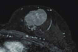MR image from a 55-year-old patient with triple-negative breast cancer from training set. (A, above) Axial postcontrast T1-weighted image from baseline MRI exam shows unifocal enhancing mass (unifocality: positive). (B, below) Axial postcontrast T1-weighted image from MRI examination per-formed after one cycle of neoadjuvant chemoimmunotherapy shows >37% reduction in lesion size (early tumor shrinkage: positive) and development of non-enhancing region within lesion (percentage enhancement reduction: positive).