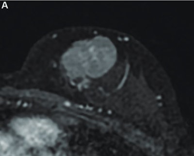 MR image from a 55-year-old patient with triple-negative breast cancer from training set. (A, above) Axial postcontrast T1-weighted image from baseline MRI exam shows unifocal enhancing mass (unifocality: positive). (B, below) Axial postcontrast T1-weighted image from MRI examination per-formed after one cycle of neoadjuvant chemoimmunotherapy shows >37% reduction in lesion size (early tumor shrinkage: positive) and development of non-enhancing region within lesion (percentage enhancement reduction: positive).