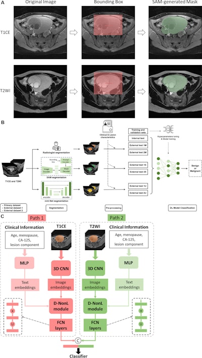 (A) Images depict the workflow of the Segment Anything Model (SAM). In a 29-year-old woman with a right ovarian mass subsequently confirmed as well-differentiated mucinous carcinoma, a bounding box (red) is placed around the lesion on axial T1-weighted contrast-enhanced (T1CE) and axial T2-weighted (T2WI) MRI scans, allowing the SAM to automatically generate a segmentation mask (green). (B) Flowchart shows the integration of preprocessed T1-weighted contrast-enhanced (T1CE) and T2-weighted (T2WI) segmented images alongside clinical data into the deep-learning (DL) model for lesion classification. (C) Flowchart shows dual-path network architecture for ovarian lesion classification, featuring components such as a multilayer perceptron (MLP), three-dimensional convolutional neural network (3D CNN), dynamic nonlinear (D-NonL) modules, elementwise addition (+), upsampling (U), and concatenation (C).