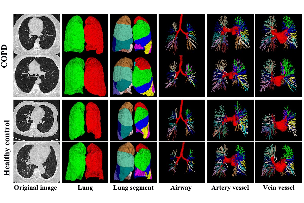 Enhancing COPD Severity Assessment with Machine Learning and CT Scans