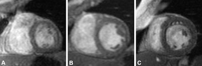 Example of noncontrast short-axis cardiac MRI scans of the heart at end diastole in participants with varying left-to-right ventricular volume ratios (LRVRs). (A) Image in a 78-year-old male with right ventricle (RV) predominance (LRVR < 0.8) with an LRVR of 0.56, left ventricular end-diastolic volume indexed to body surface area (LVEDVi) of 44.44 mL/m2, and right ventricular end-diastolic volume indexed to body surface area (RVEDVi) of 79.88 mL/m2. (B) Image in a 65-year-old male with balanced left ventricle (LV)–RV with an LRVR of 1, LVEDVi of 62.07 mL/m2, and RVEDVi of 62.07 mL/m2. (C) Image in a 74-year-old female with LV predominance (LRVR > 1.3) with an LRVR of 2.06, LVEDVi of 94.81 mL/m2, and RVEDVi of 46.1 mL/m2.