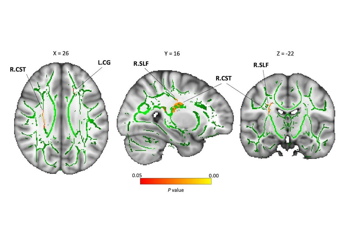 DTI-MRI shows childhood neglect's effect on the brain's white matter ...