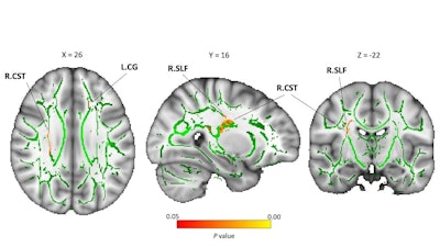 Larger white-matter fiber tracts were observed in the neglected group compared with the typically developing group. Slices of the mean fractional anisotropy skeleton (green), overlaid with red clusters, depict significantly higher axial diffusivity values in the neglected group than in the typically developing group. Image courtesy of Akemi Tomoda, MD, PhD, from the University of Fukui, Japan, and used according to Creative Commons License CC BY NC ND 4.0.