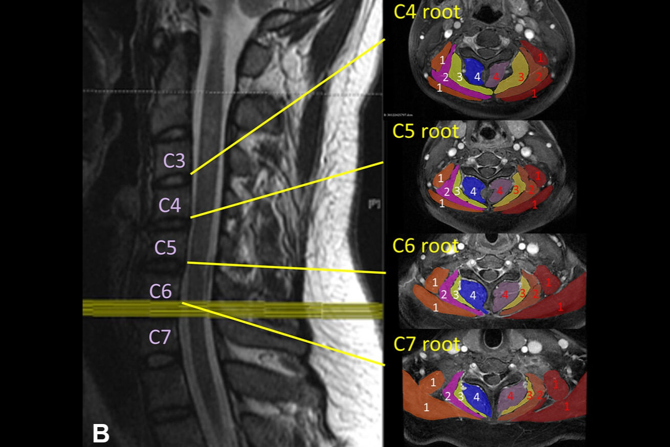 2025 08 26 Nerve Injury Thumbnail