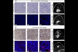 2025 08 26 Radiology Mri Tumor Shrinkage Model Thumbnail