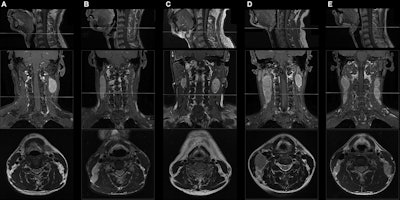 Sagittal T1-weighted fat-suppressed contrast-enhanced MRI scans (top row) show the caudal border of the hyoid bone. Coronal T1-weighted fat-suppressed contrast-enhanced (middle row) and axial T2-weighted MRI scans (bottom row) show the presence or absence of middle neck involvement in five patients with N1 or N2 nasopharyngeal carcinoma (NPC). (A) A 49-year-old male patient with N1 NPC and without middle neck involvement. (B) A 45-year-old male patient with N1 NPC and middle neck involvement. (C) A 49-year-old male patient with N2 NPC and without middle neck involvement. (D) A 30-year-old female patient with N2 NPC and unilateral middle neck involvement. (E) A 19-year-old male patient with N2 NPC and bilateral middle neck involvement.