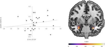 Gray-matter volume changes in the amygdala within patients and the association with improvements in alexithymia (Difficulty Identifying Feelings). (Left) Scatter plots depicting GMV changes (delta = t2-t1) within the cluster of the right amygdala (x = 32, y = −3, z = −27) on the y-axis correlated with changes (delta = t1-t2) in the Toronto Alexithymia Scale (TAS20) subscale Difficulty Identifying Feelings (DIF; rs = 0.321, p = 0.042) on the x-axis within the patient group. Line: regression slope. (Right) Coronal view (Montreal-Neurological-Institute coordinate y = 0) depicts the results of the paired t-tests (t1 vs. t2) in the patient group within the bilateral amygdala. Graphics, images, and caption courtesy of Translational Psychiatry via a Creative Commons License.