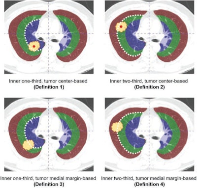 (A) Definition 1 (inner one-third, tumor center–based): assigned when tumor center (red dot on yellow tumor) lies within inner one-third of lung (white dot-bordered blue area). (B) Definition 2 (inner two-thirds, tumor center–based): assigned when tumor center lies within either inner or middle third (white dot-bordered blue or green area). (C) Definition 3 (inner one-third, tumor medial margin–based): assigned when tumor’s medial margin falls within inner one-third (white dot-bordered blue area). (D) Definition 4 (inner two-thirds, tumor medial margin–based): assigned when medial margin falls within either inner or middle third (white dot-bordered blue or green area). Image and caption courtesy of the ARRS.