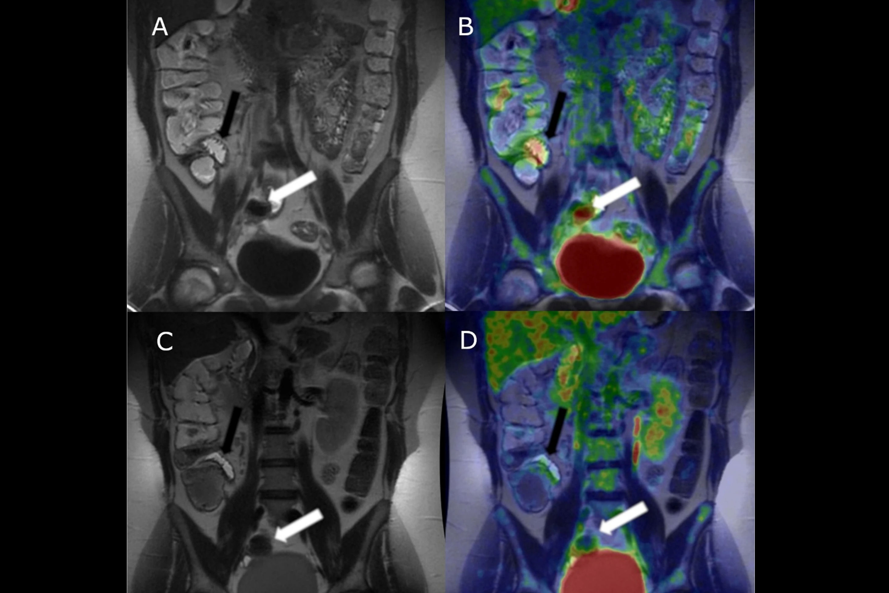 2025 08 29 Crohns Mre Thumbnail