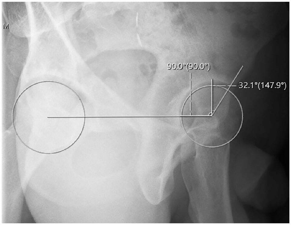 Anterior center edge angle measurement utilizing a horizontal reference line.