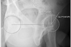 Anterior center edge angle measurement utilizing a horizontal reference line.
