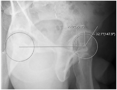 Anterior center edge angle measurement utilizing a horizontal reference line.
