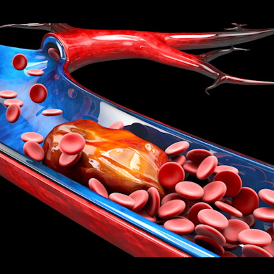Blood Vessel Embolism Dvt 400