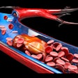 Blood Vessel Embolism Dvt 400