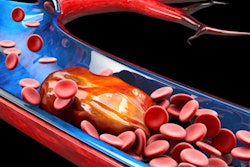 Blood Vessel Embolism Dvt 400