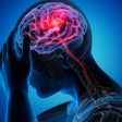 Brain Stroke Stroke