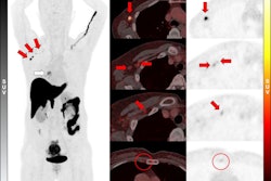 A 58-year-old woman was diagnosed with ER-positive (Allred score 8) ILC in her right breast. Ultrasound and MRI found prominent lymph nodes in right axillary level I area, diagnosed as metastasis on ultrasound-guided fine-needle aspiration. F-18 FES-PET/CT showed a positive mass in right breast (white arrow; SUVmax, 5.6) and multiple F-18 FES–positive lymph nodes in right axillary level I, II, and II/III junction areas (red arrows; SUVmax, up to 12.2). In addition, a small F-18 FES-positive lymph node was observed in the right second internal mammary area (red circles; SUVmax, 1.8). However, biopsy could not be performed because it was too small and not visible on ultrasound; the clinician decided to include internal mammary lymph node in treatment field for adjuvant radiotherapy. The patient underwent lumpectomy with ALN dissection, with five metastases being identified in 13 lymph nodes dissected, and is scheduled to receive adjuvant chemotherapy, radiotherapy, and endocrine therapy.