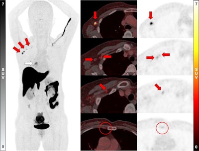 A 58-year-old woman was diagnosed with ER-positive (Allred score 8) ILC in her right breast. Ultrasound and MRI found prominent lymph nodes in right axillary level I area, diagnosed as metastasis on ultrasound-guided fine-needle aspiration. F-18 FES-PET/CT showed a positive mass in right breast (white arrow; SUVmax, 5.6) and multiple F-18 FES–positive lymph nodes in right axillary level I, II, and II/III junction areas (red arrows; SUVmax, up to 12.2). In addition, a small F-18 FES-positive lymph node was observed in the right second internal mammary area (red circles; SUVmax, 1.8). However, biopsy could not be performed because it was too small and not visible on ultrasound; the clinician decided to include internal mammary lymph node in treatment field for adjuvant radiotherapy. The patient underwent lumpectomy with ALN dissection, with five metastases being identified in 13 lymph nodes dissected, and is scheduled to receive adjuvant chemotherapy, radiotherapy, and endocrine therapy.