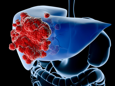 Liver Cancer (1)