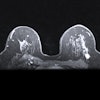 Mri Breast 400