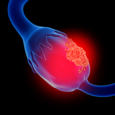 Ovarian Cancer2 400