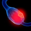 Ovarian Cancer2 400