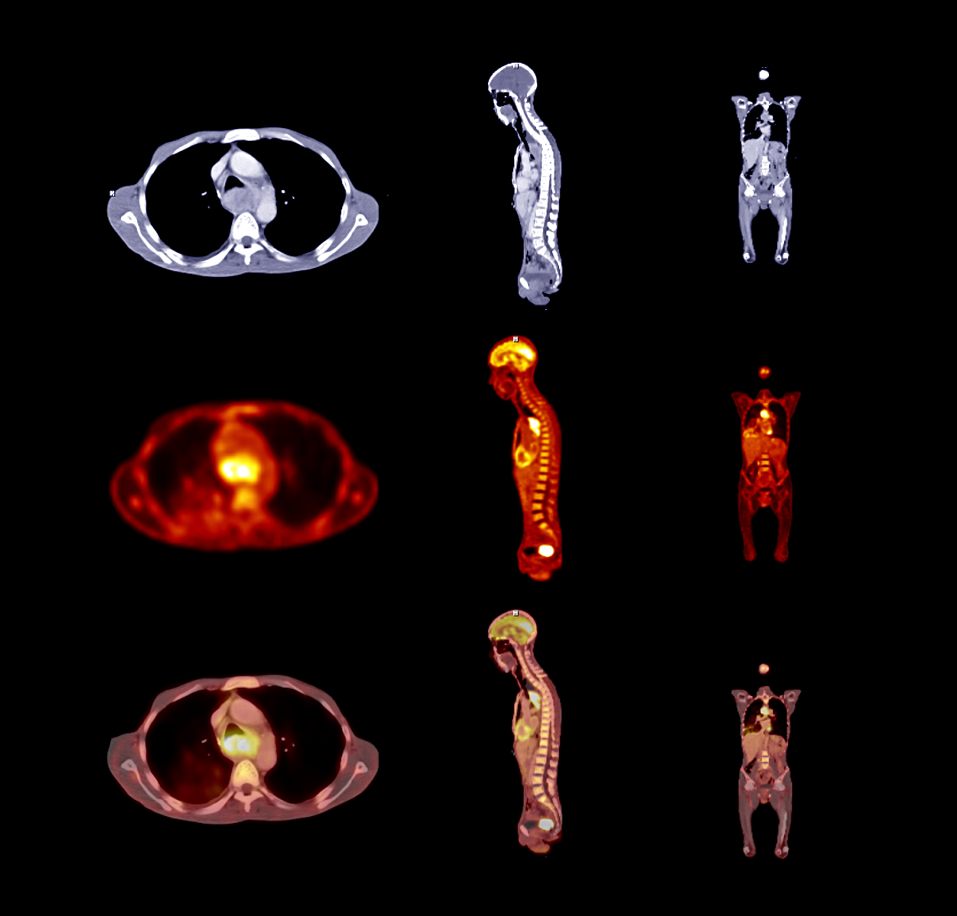 Pet Ct Scan