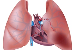 Pulmonary Embolism