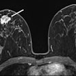 2025 09 02 Radiology Idc Ilc Noderads Thumbnail A