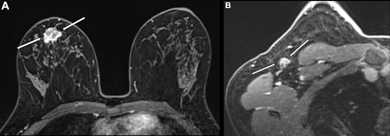 Node-RADS evaluates breast cancers on MRI exams | AuntMinnie