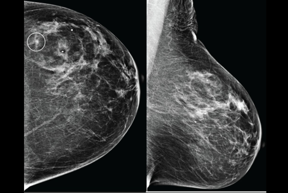 2025 09 03 Ajr Ai Breast Images Thumbnail