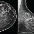 2025 09 03 Ajr Ai Breast Images Thumbnail