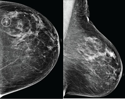 Craniocaudal (left) and mediolateral oblique (right) digital mammography images of the left breast were assessed by interpreting radiologist as BI-RADS category 1, consistent with negative result. The AI system flagged asymmetry in lateral breast on the craniocaudal view (circle) and categorized examination as intermediate risk, consistent with negative or positive result depending on threshold used for categorizing AI results. The patient was not diagnosed with breast cancer within one year after screening examination, consistent with negative outcome according to present study’s reference standard. Thus, interpretation by radiologist was true negative and by AI system was positive if defining both intermediate-risk and elevated-risk categories as positive. Annotation was not generated by the AI system but rather was recreated by present authors based on AI output coordinates.