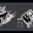 2025 09 05 Isct Temporal Bone Ossicular Impact Pcct Imaging Thumbnail