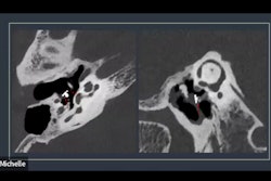 2025 09 05 Isct Temporal Bone Ossicular Impact Pcct Imaging Thumbnail