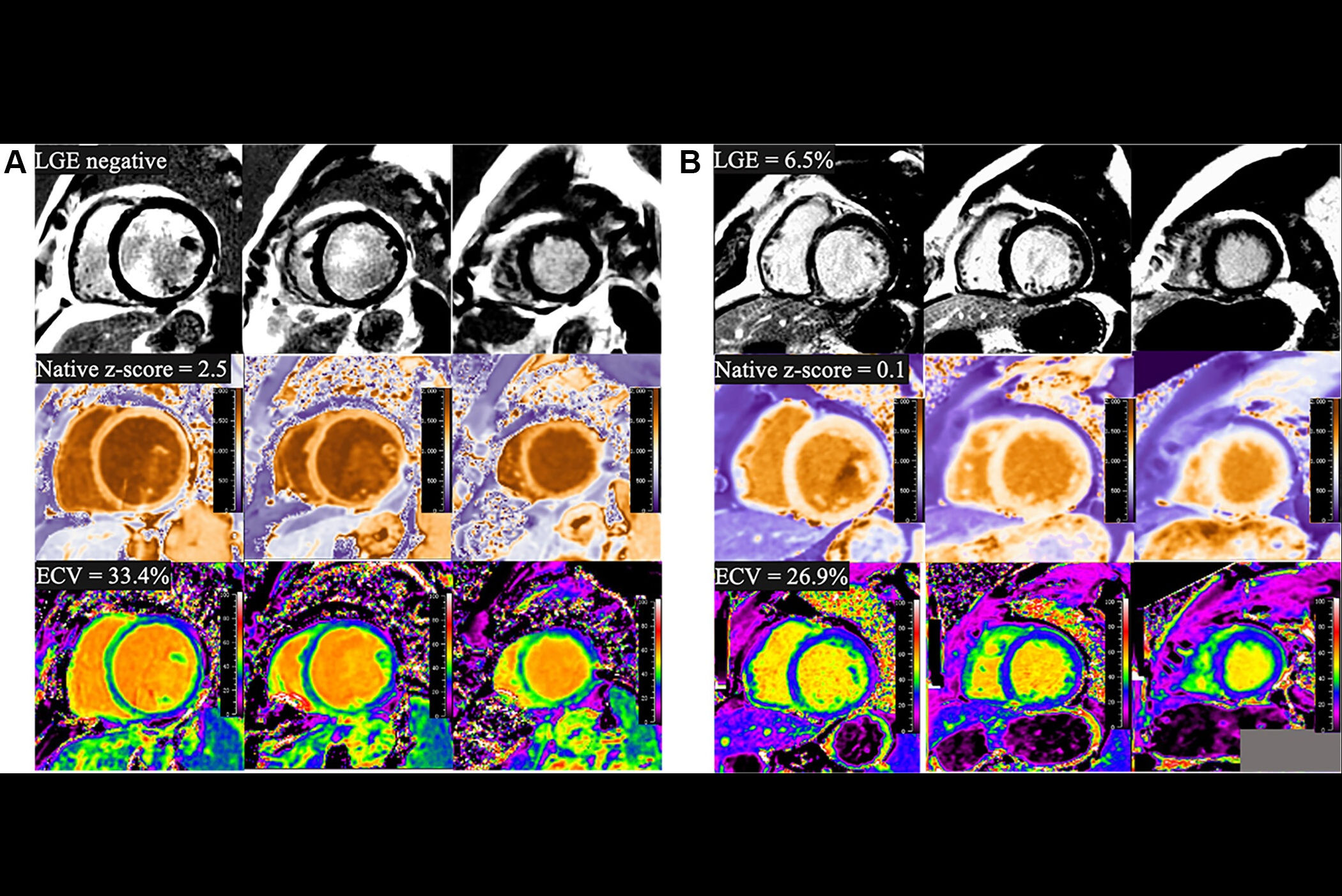 2025 09 09 Lge Dilated Cardiomyopathy Thumbnail