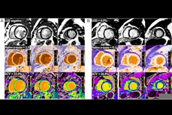 2025 09 09 Lge Dilated Cardiomyopathy Thumbnail